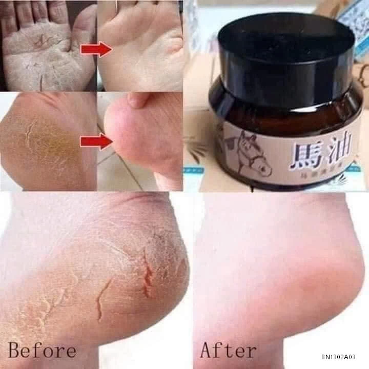 SÉT 3 LỌ KEM CAO NGỰA TRỊ NỨT GÓT CHÂN